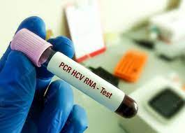 Hepatitis C Virus (HCV) Viral Load Test